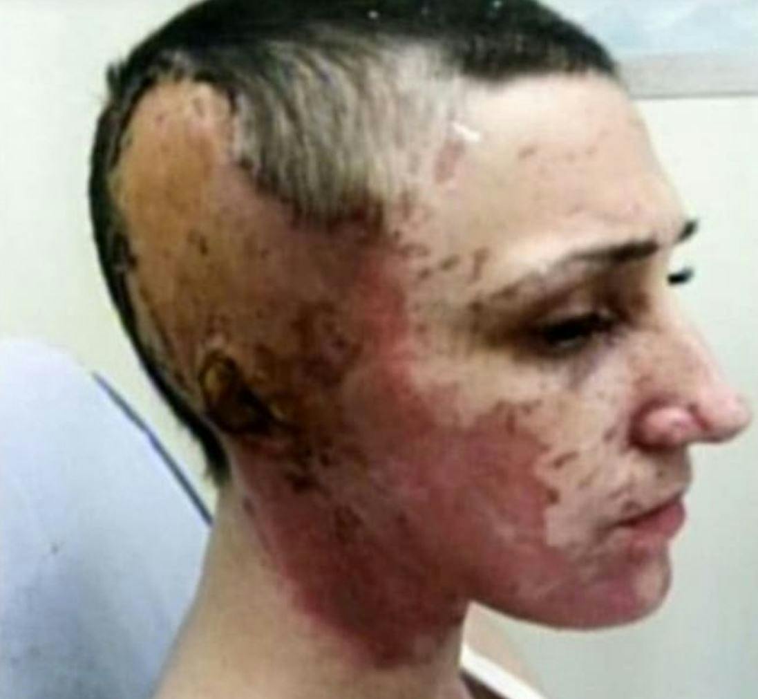 https://imgix.seoghoer.dk/2019-02-27_14_32_23-beautician_who_survived_acid_attack_that_left_her_with_one_ear_and_scarred_for_l.jpg