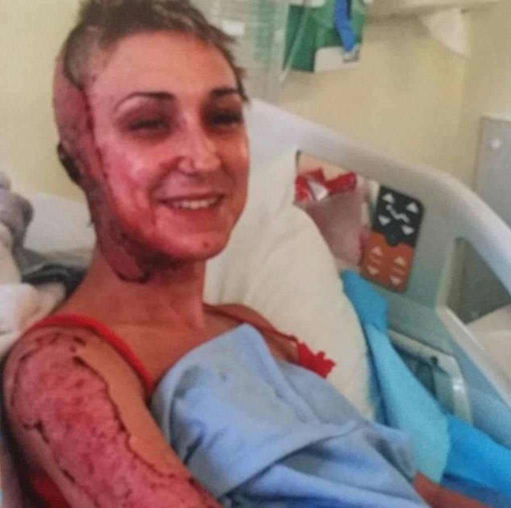 https://imgix.seoghoer.dk/2019-02-27_14_33_33-beautician_who_survived_acid_attack_that_left_her_with_one_ear_and_scarred_for_l.jpg
