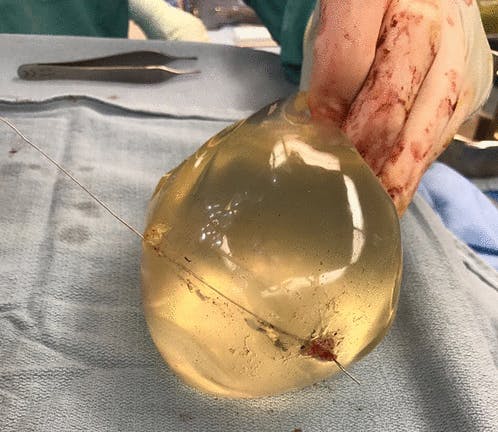 https://imgix.seoghoer.dk/2020-04-23_10_14_55-life-saving_silicone_breast_implant_after_firearm_injury_case_report_and_treatm.png