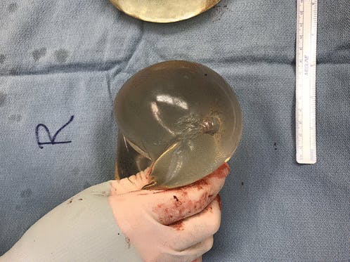 https://imgix.seoghoer.dk/2020-04-23_10_15_12-life-saving_silicone_breast_implant_after_firearm_injury_case_report_and_treatm.png