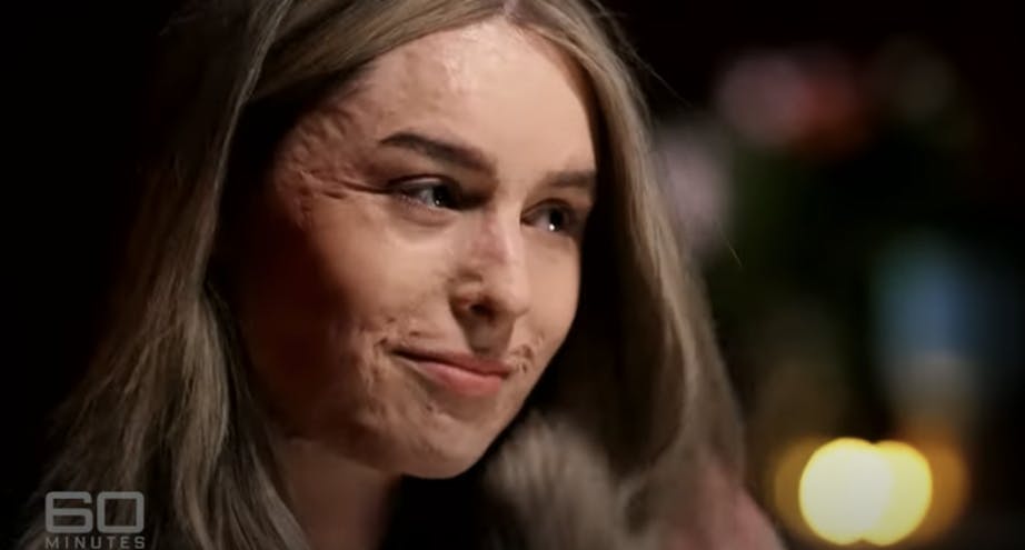 Stephanie blev forbrændt på 70 procent af kroppen - og også i ansigtet. Hun har siden ulykken båret en kompressionsmaske for at beskytte den sarte hud i ansigtet. 