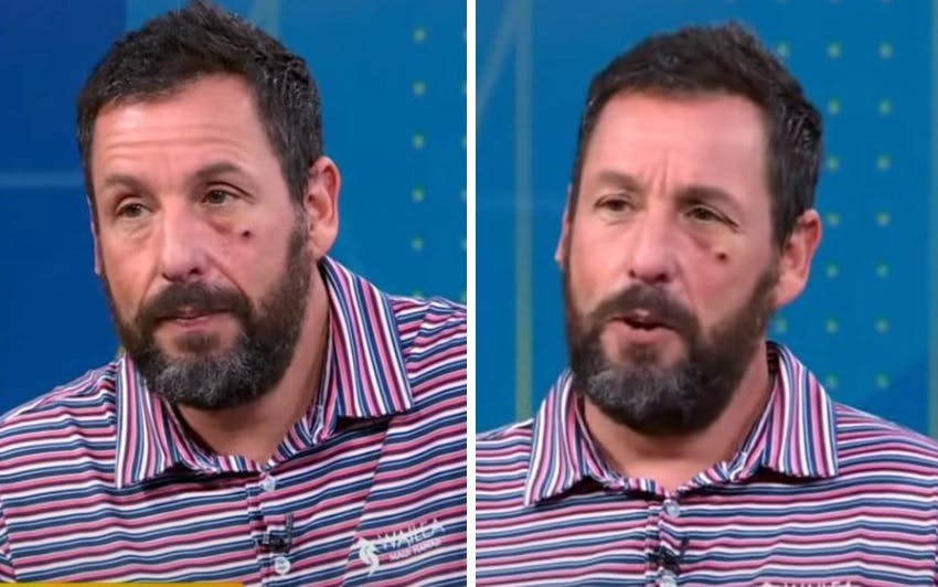 Adam Sandler med sin skramme under det ene øje.