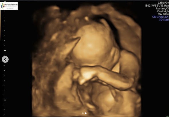 Chloe er gravid med en syg baby, men kan ikke få en abort, selv om barnet ikke kan overleve.