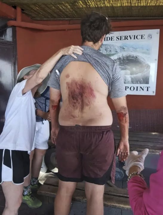 De voldsomme skader, som den 23-årige pådrog sig, da han faldt ned i vulkanen. 