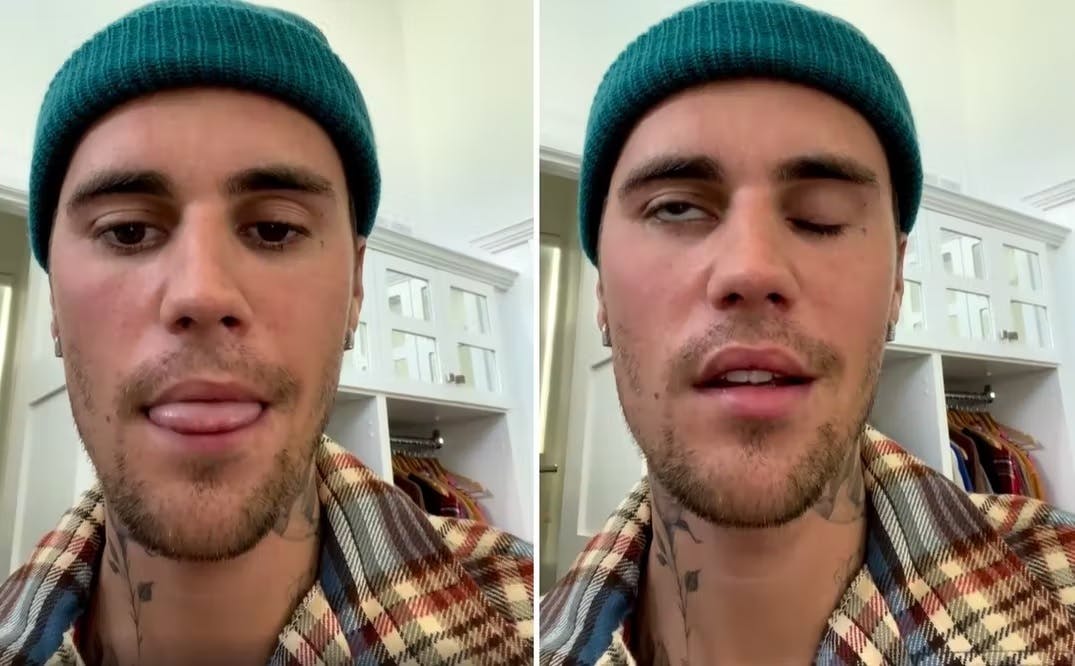 Sådan så Justin Bieber ud, da han i sidste måned fortalte om sin sygdom i en video på Instagram.
