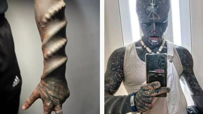Anthony Loffredo har blandt andet få implantater i sin arm og fået fjernet to fingre. nbsp;