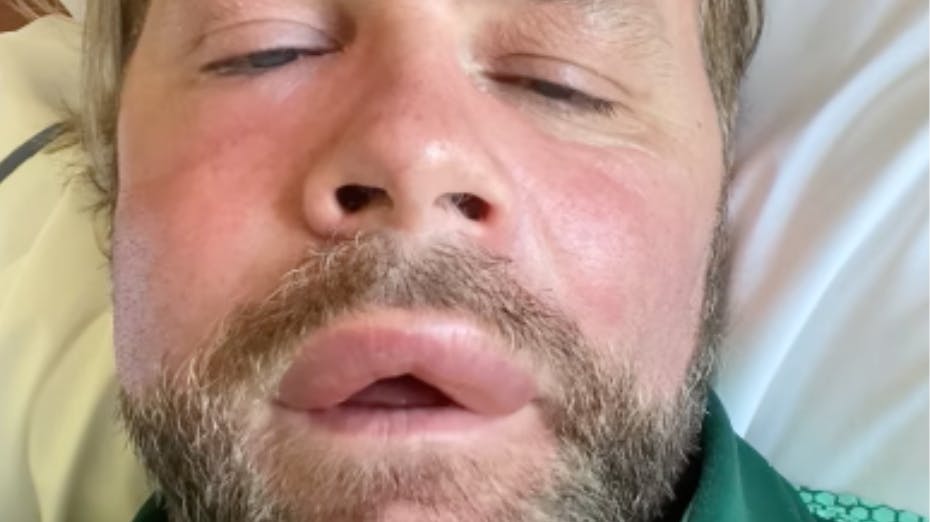 Popstjernen Brian McFaddener ikke til at kende, efter et bistik har efterladt ham med et meget hævet ansigt.