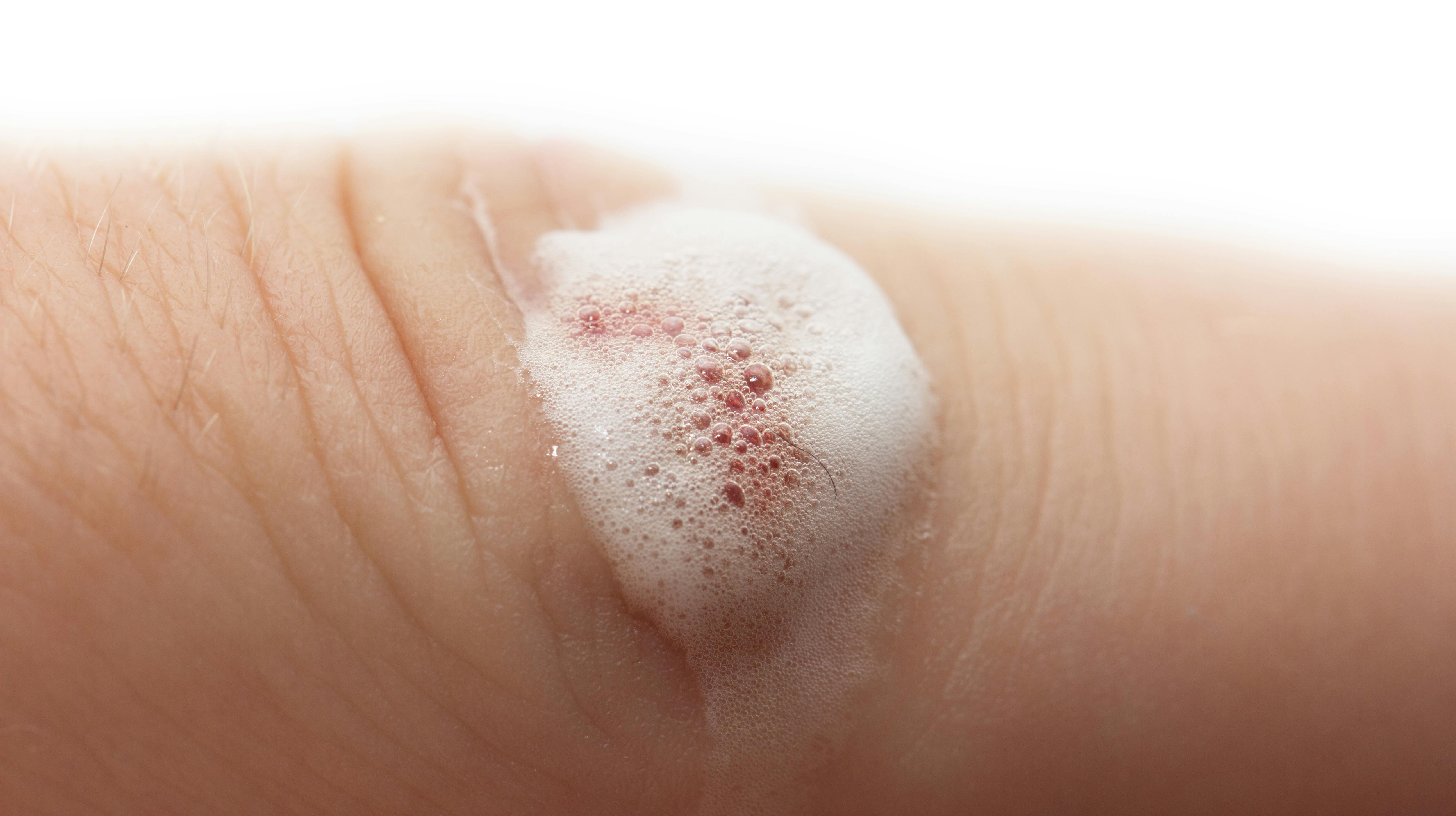 Brintoverilte bruges normalt til desinfektion, som blegemiddel og i plastindustrien.