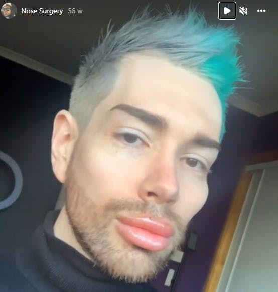 Det er tydeligt, at både læber og kindben er forandret.