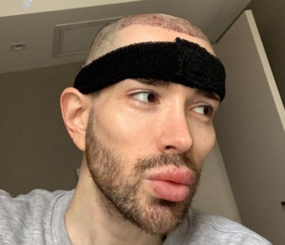 David gør klar til hårtransplantation.