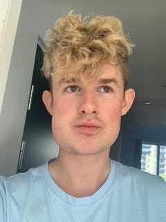 Zilas Gregersen har fået fjernet to visdomstænder