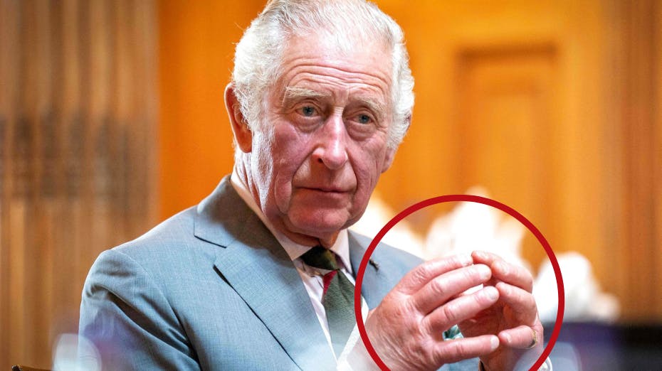 Flere spekulerer i, hvorfor kong Charles' hænder og fingre er SÅ hævede. nbsp;
