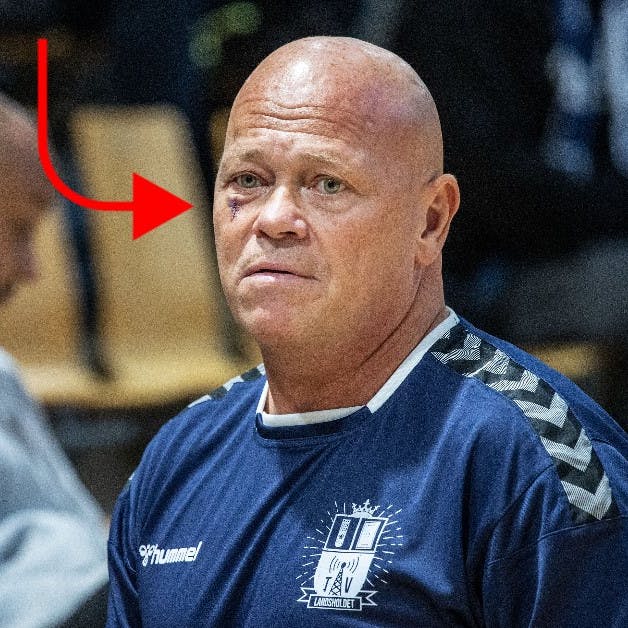 Det er tydeligt, hvor lægerne har været nødt til at operere Stig Tøftning.