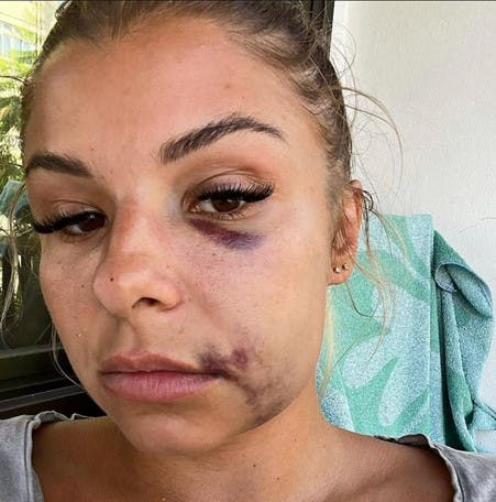 Nynne Larsen delte det her billede efter parrets brud i august sidste år. Episoden er nu endt med en tiltale om vold mod Robert Hansen.