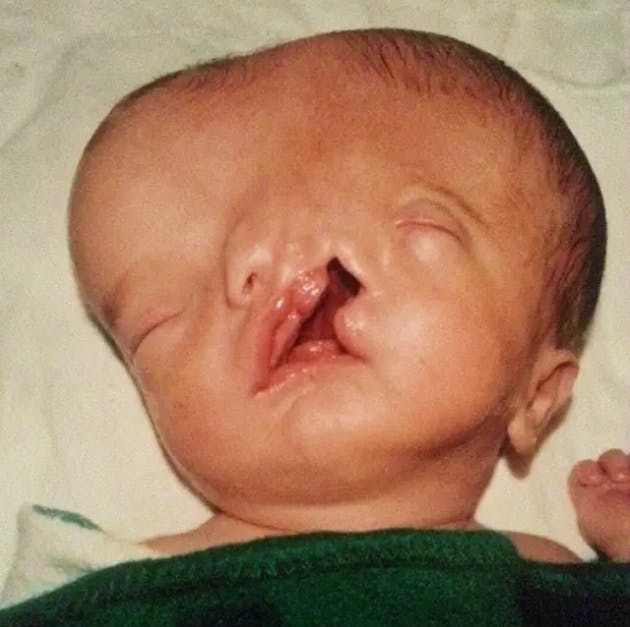 Tres er her fotograferet på sin første dag uden en respirator. Han blev født med en dyb kløft i ansigtet og en voldsom deformitet i kraniet. 
