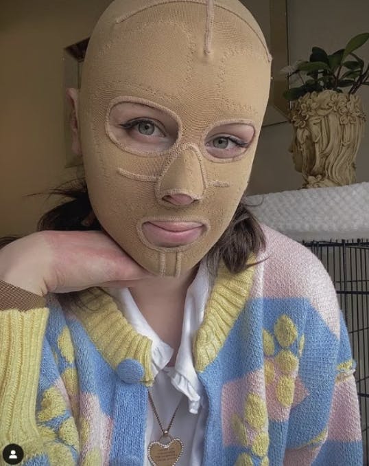 Stephanie Browitt bar i flere år denne maske for at hendes ansigt kunne hele bedst mulig. 
