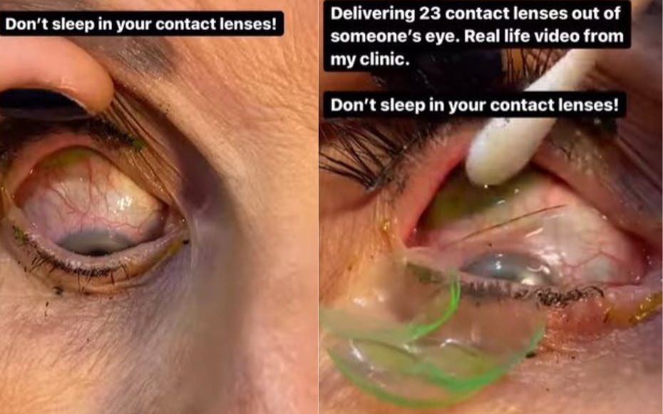 Frygtelig video: Kvinde får kontaktlinser fra sit øje og HØR