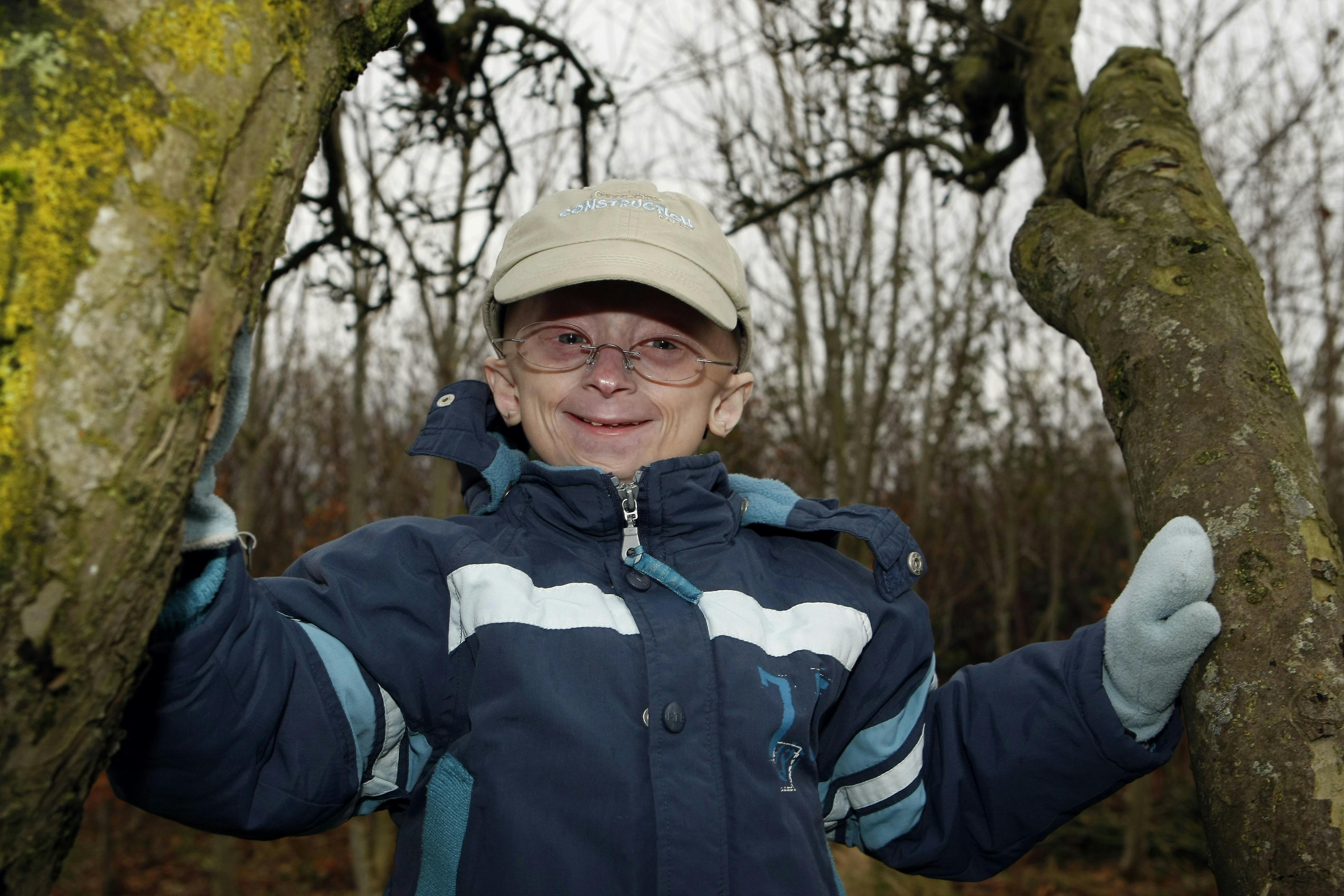 Personer med progeria bliver i gennemsnit 13 år. Derfor har Jesper Sørensen, 25, fra Nordjylland i den grad bevist, at han er noget særligt.
