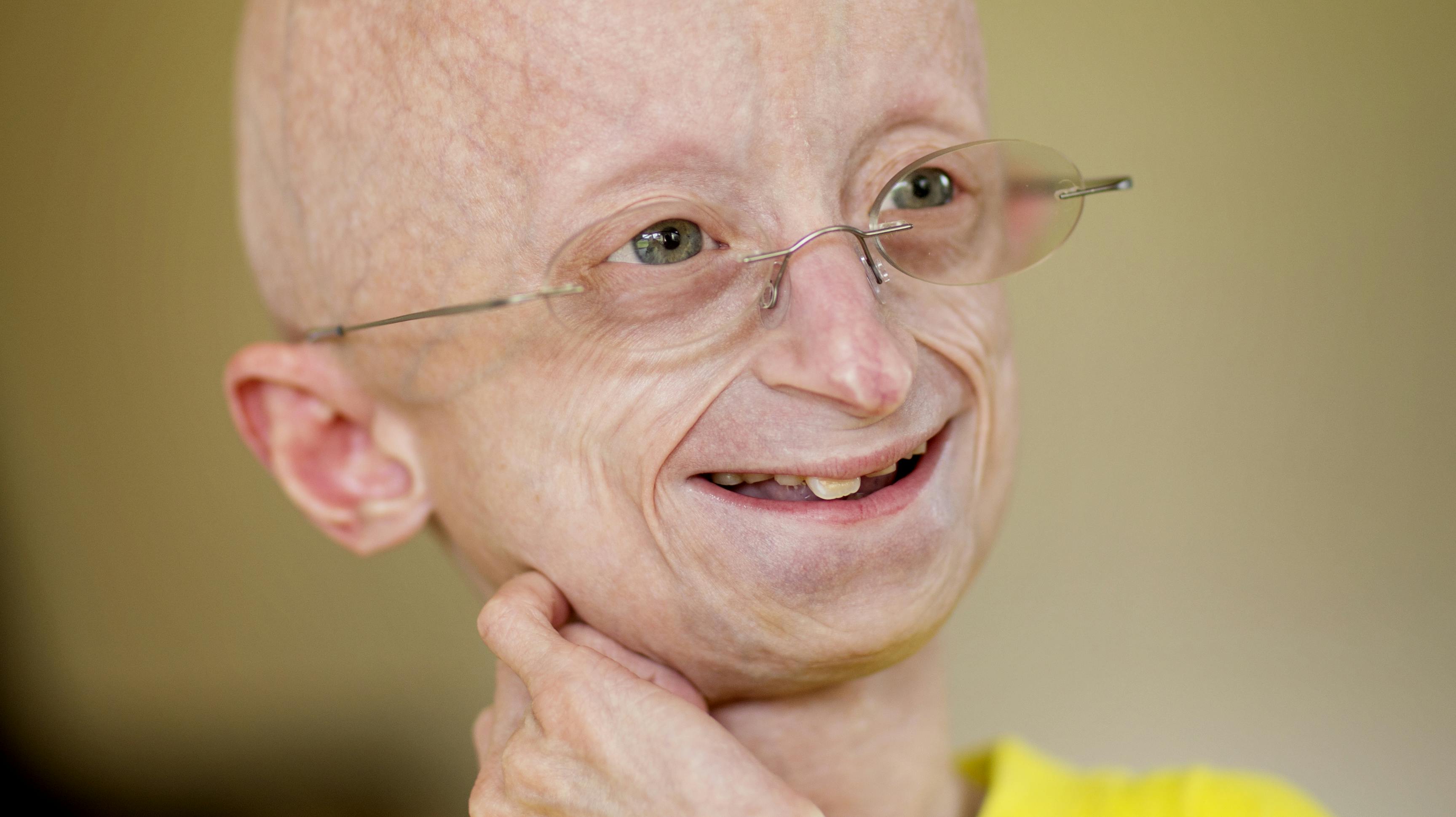 Jesper Sørensen er født med den sjældne sygdom progeria. Nu har han nået en stor milepæl: Han er fyldt 25 år.
