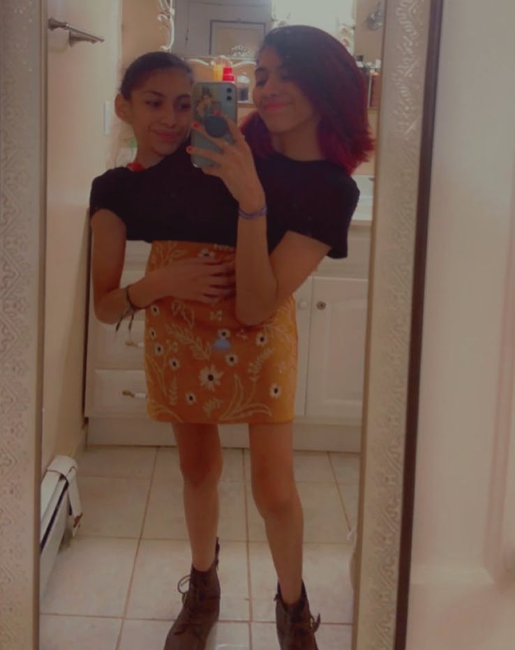 De 22-årige mexicanske kvinder har hver to arme, men må deles om et sæt ben, da de er sammenvokset ved navlen.