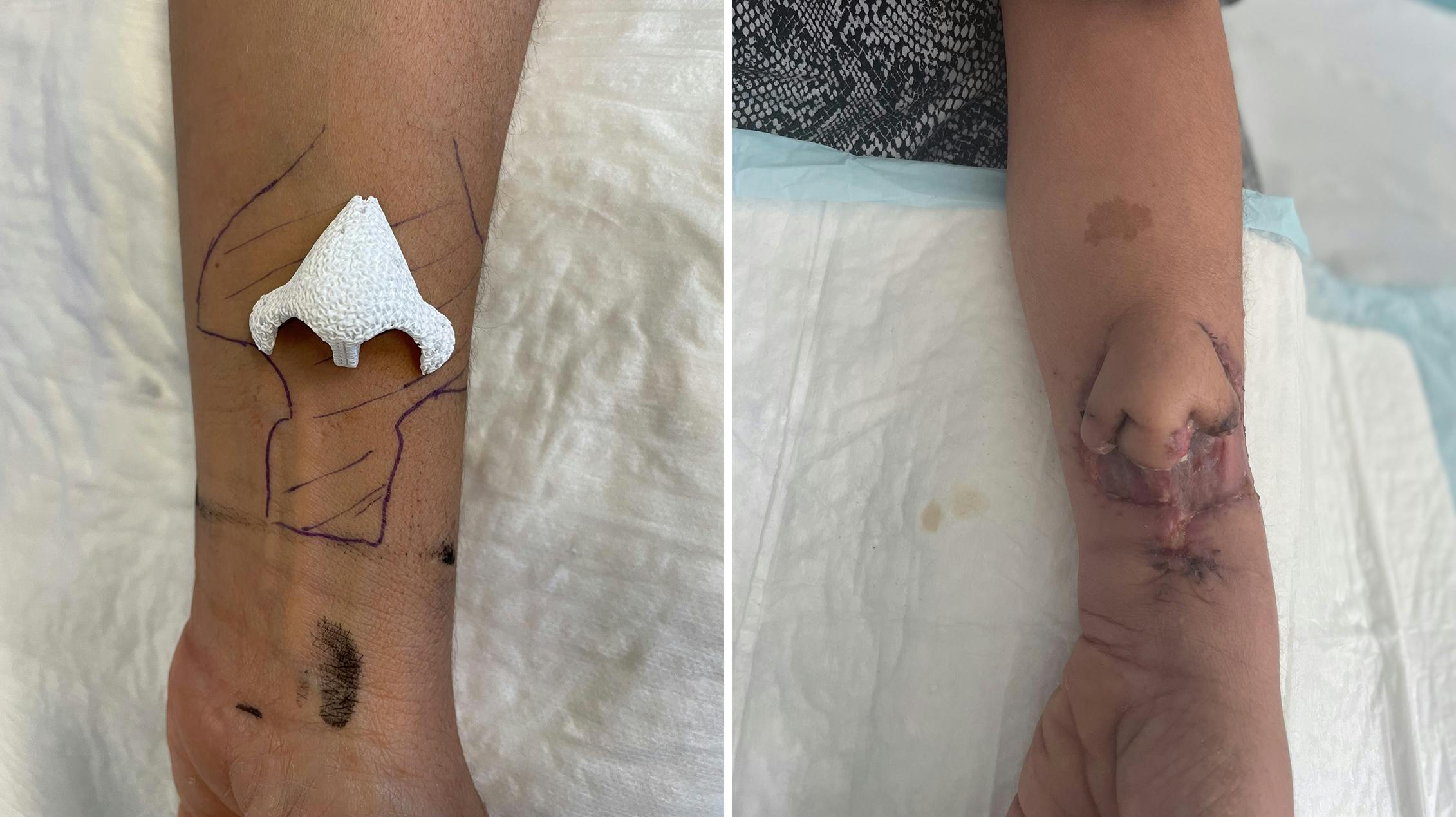 To måneder tog det franske læger at "dyrke" en ny næse på en kvindes arm. nbsp;