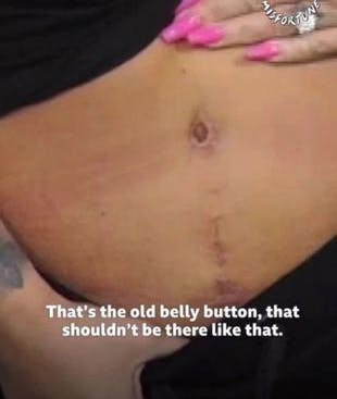 Arvævet efter operationen gør, at det nu ligner, popstjernen har to navler. 