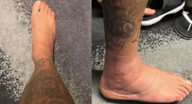 Det lignede umiddelbart ikke, at Neymars ankel ville nå at blive klar.