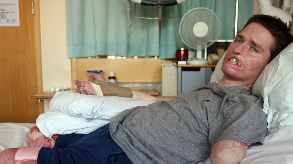 Da britiske Alex Lewis vågnede op med ondt i kroppen en tidlig novemberdag i 2013, troede han blot, at han var blevet ramt af en influenza. Men har var alvorligt syg, og for at overleve måtte lægerne fjerne alle hans lemmer. 