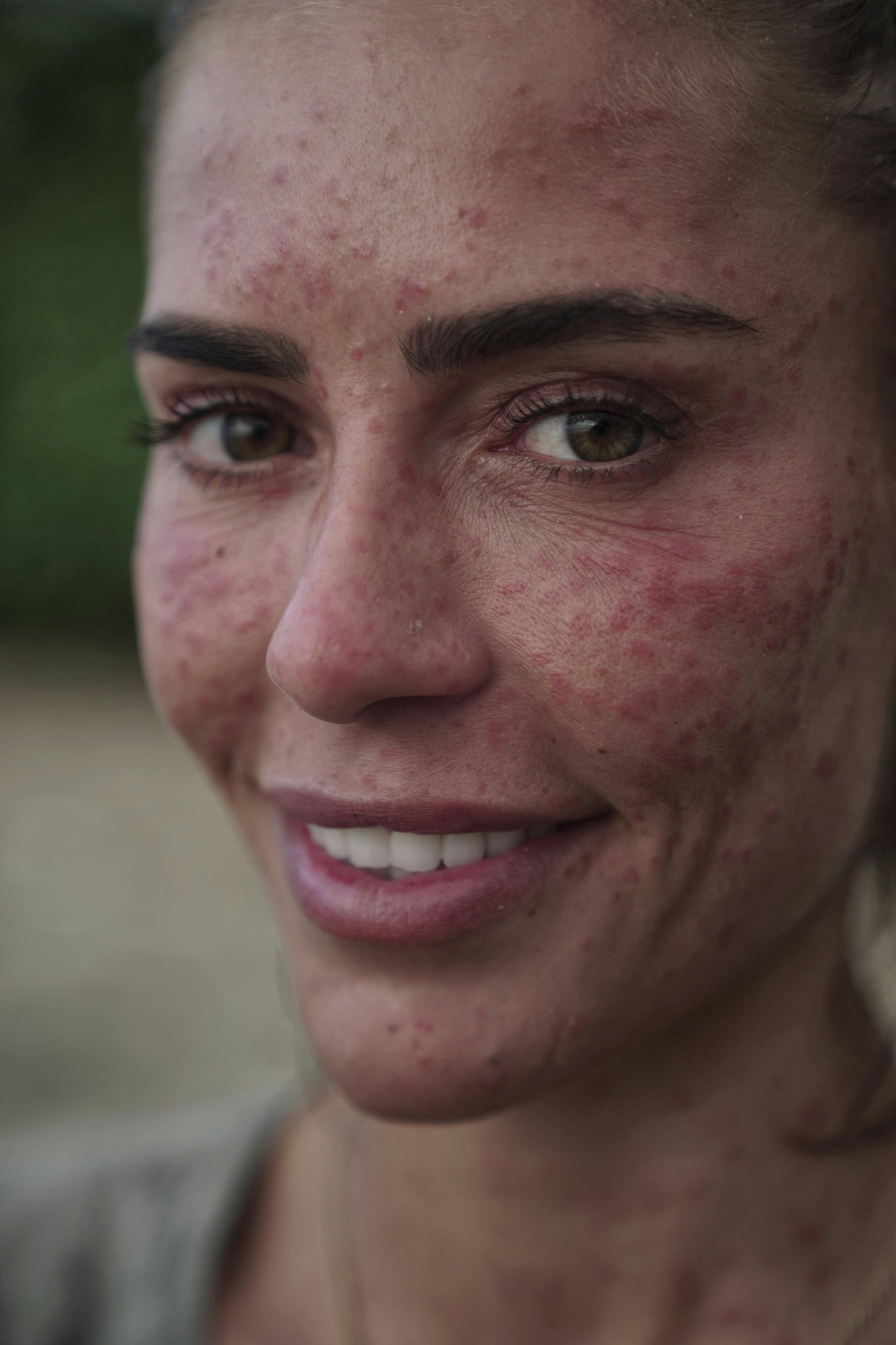 Også sandfluerne fik fat i den 30-åriges krop. Over 5.000 bid havde modellen rundt omkring på kroppen. 