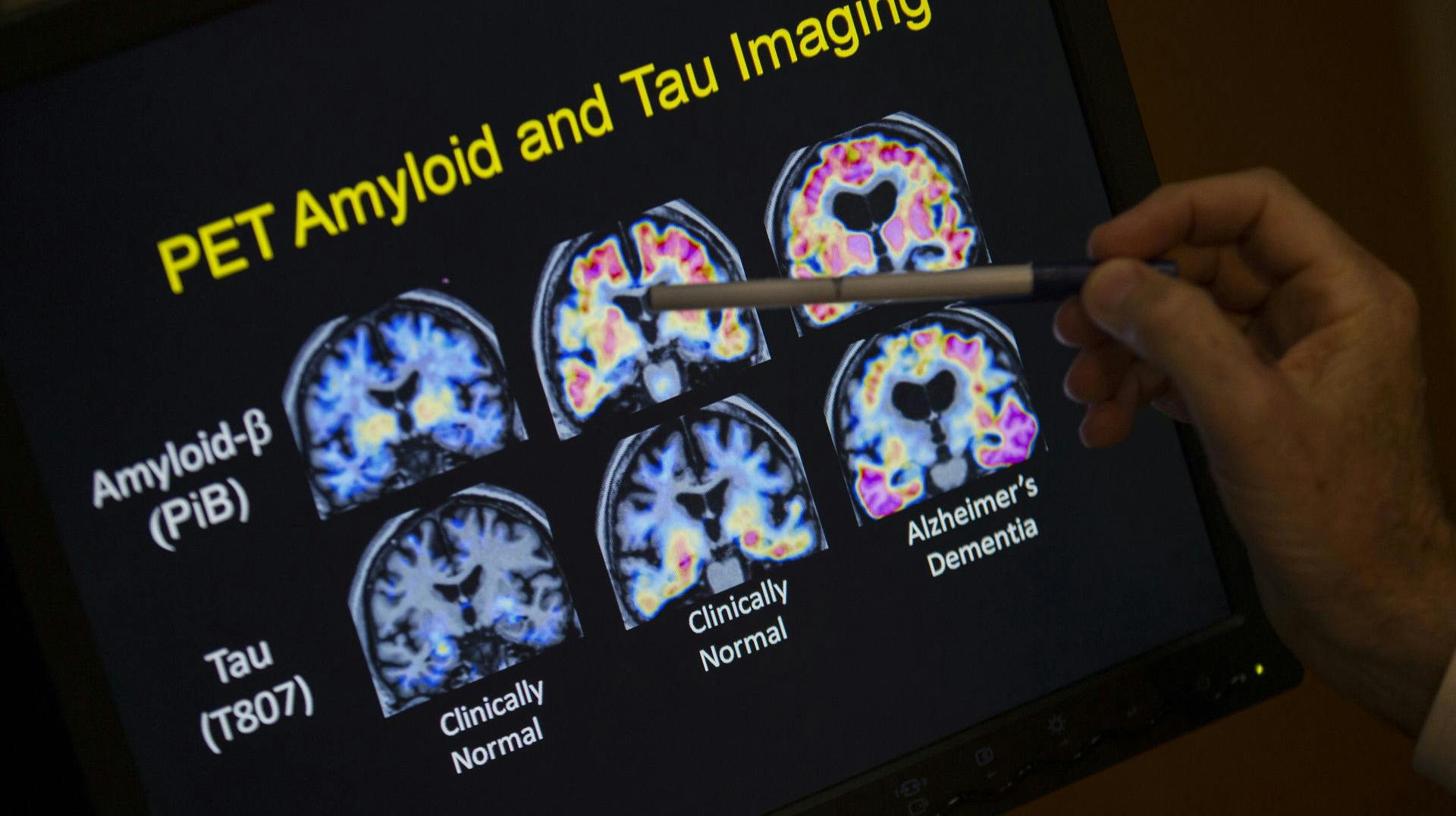 En 19-årig er blevet diagnoseret med Alzheimers, og han skulle samtidig tage den kedelige rekord om at være den yngste diagnoseret med sygdommen nogensinde.