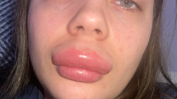 Den smertefulde oplevelse resulterede i en allergisk reaktion og slutteligt et sæt læber uden fylde.