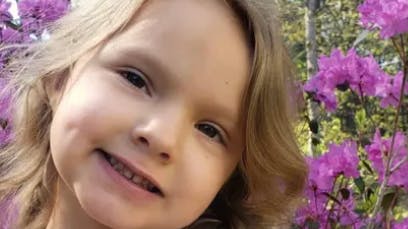 Den lille pige Lily Norton var igennem en 12 timers lang operation, der efterlod hende med 12 sting i ansigtet. 