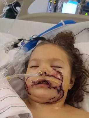 Ifølge lægerne komme Lily Norton ikke til at kunne smile igen. 