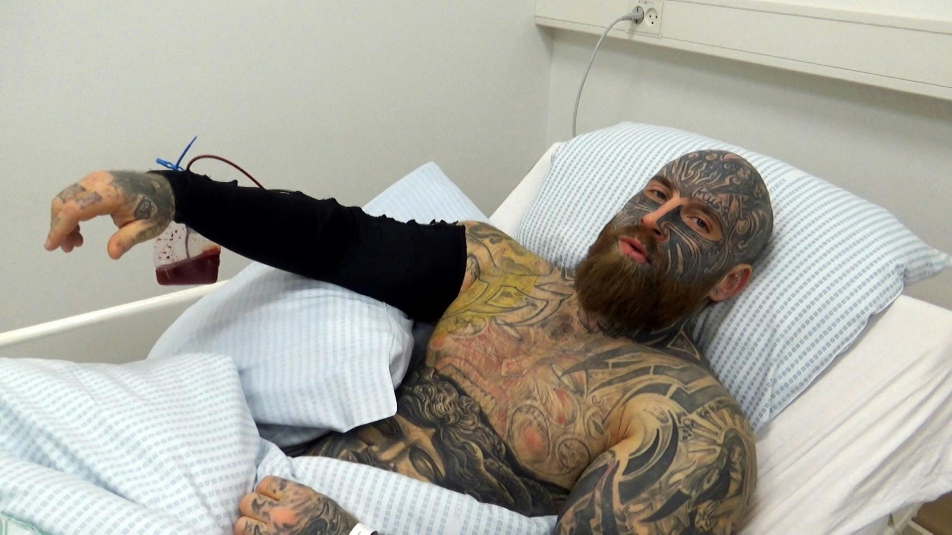 Jens måtte igennem mange operationer for at få resterne af paraffinolie ud af armene.