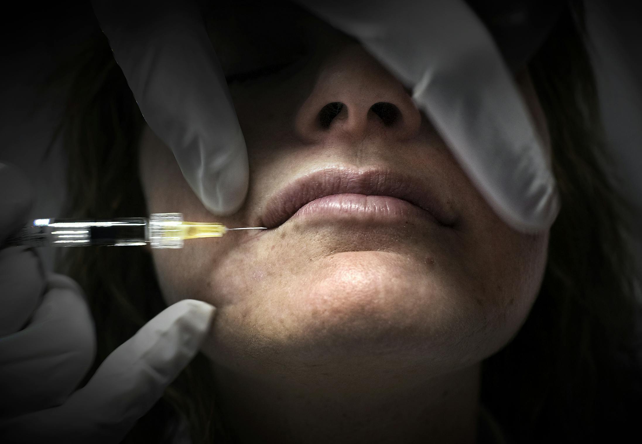 Også indenfor Danmarks grænser har behandlinger med botox været i eksplosiv stigning de seneste år. 