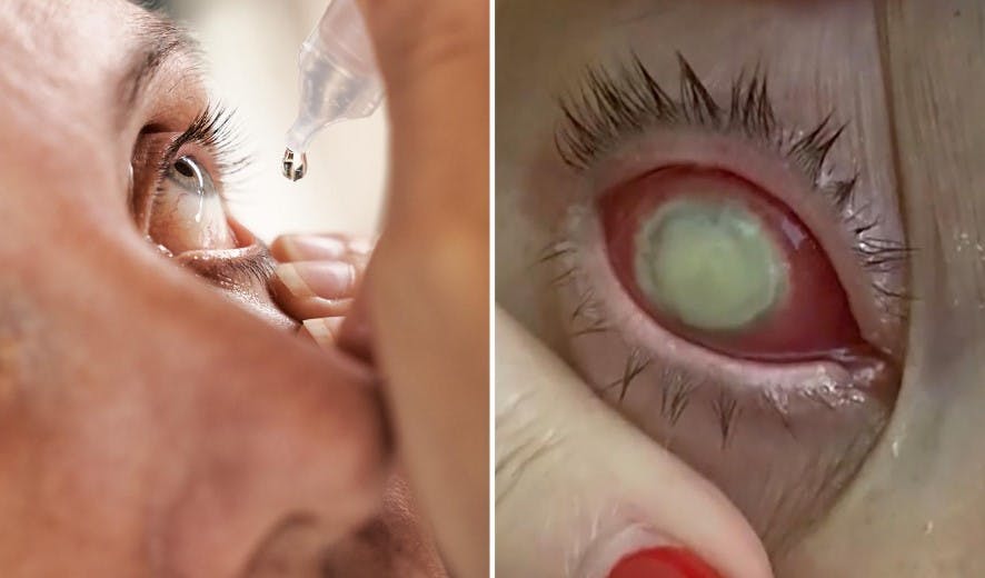 Det har fået store konsekvenser for flere, efter de har brugt øjendråber fra EzriCare Artificial Tears.