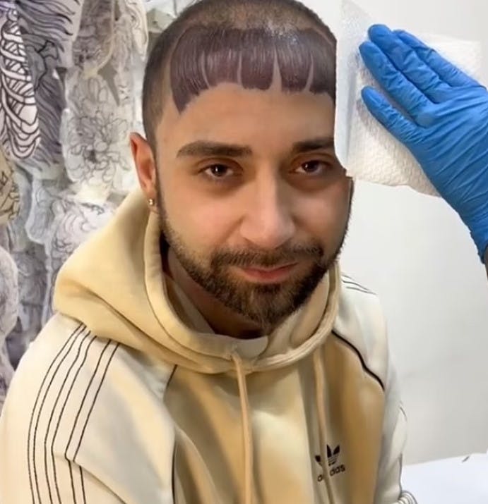 Italienske Gianluca har forsøgt at løse problemet med høje tindinger ved at få en tatovering.