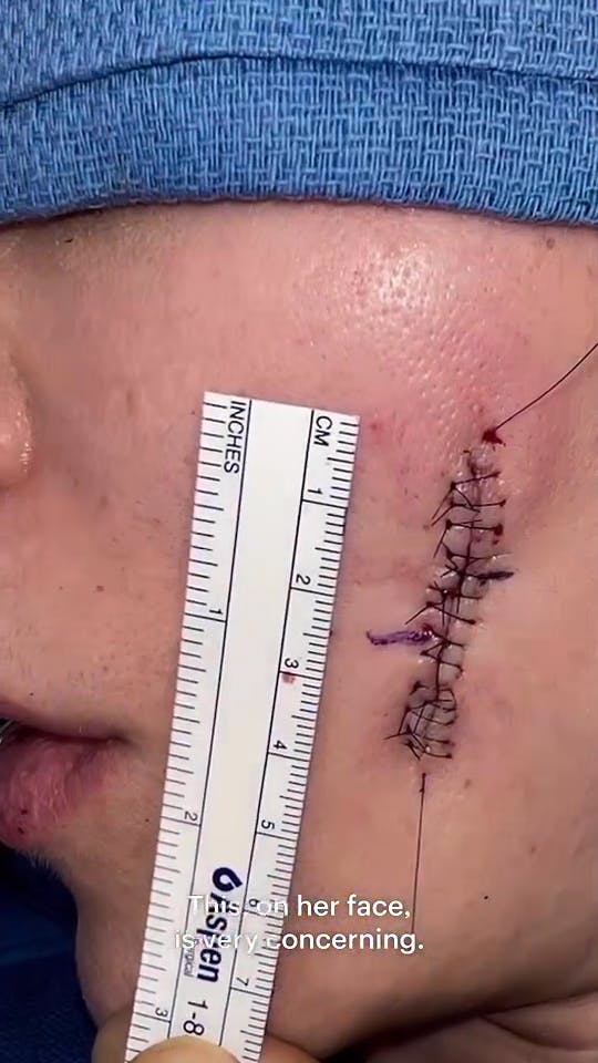 Khloé Kardashian viser sit skræmmende ar frem i ny trailer til "The Kardashians" sæson tre. 