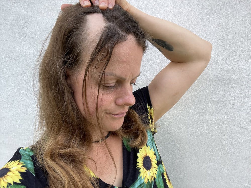 Da Helene kom til en speciallæge, fik hun at vide, at det højst sandsynligt var pletskaldethed.