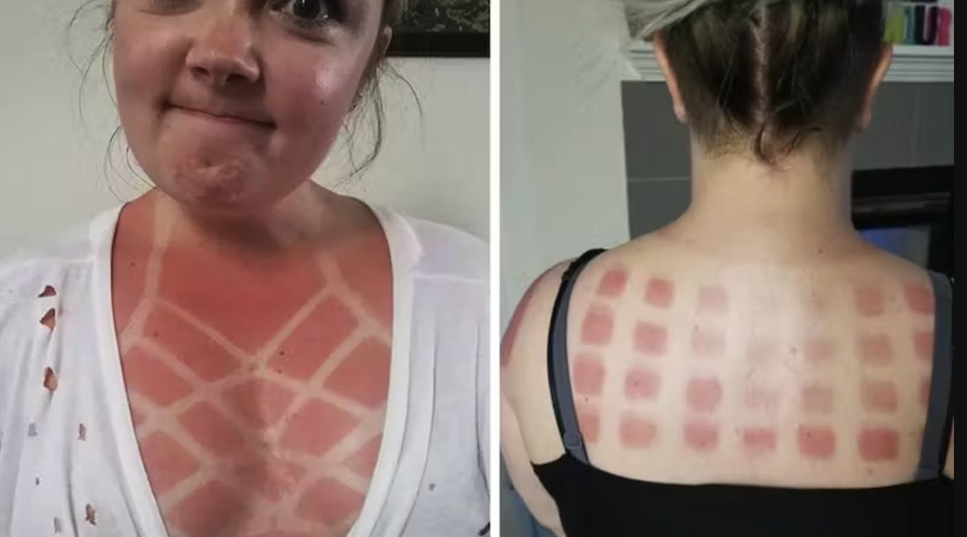 Der er ingen grund til at se sådan her ud, så husk nu solcremen!
