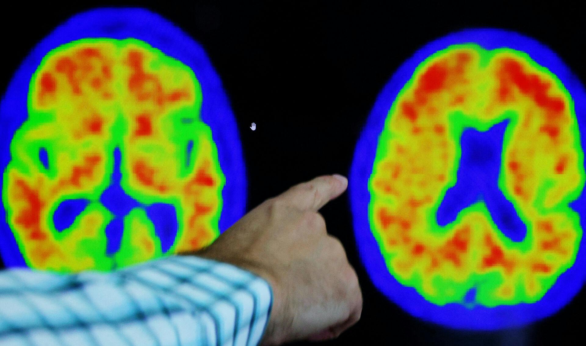 FILE PHOTO: Dr. Seth Gale points out evidence of Alzheimer's disease on PET scans at the Center for Alzheimer Research and Treatment (CART) at Brigham And Women's Hospital in Boston, Massachusetts, U.S., March 30, 2023. REUTERS/Brian Snyder/File Photo