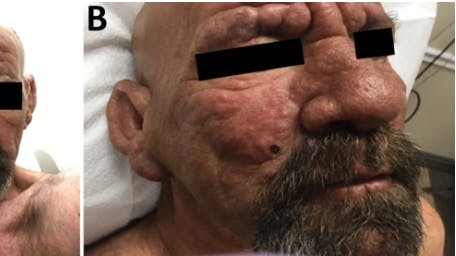 En 54-årig mand fra det centrale Florida blev diagnosticeret med spedalskhed i 2022 