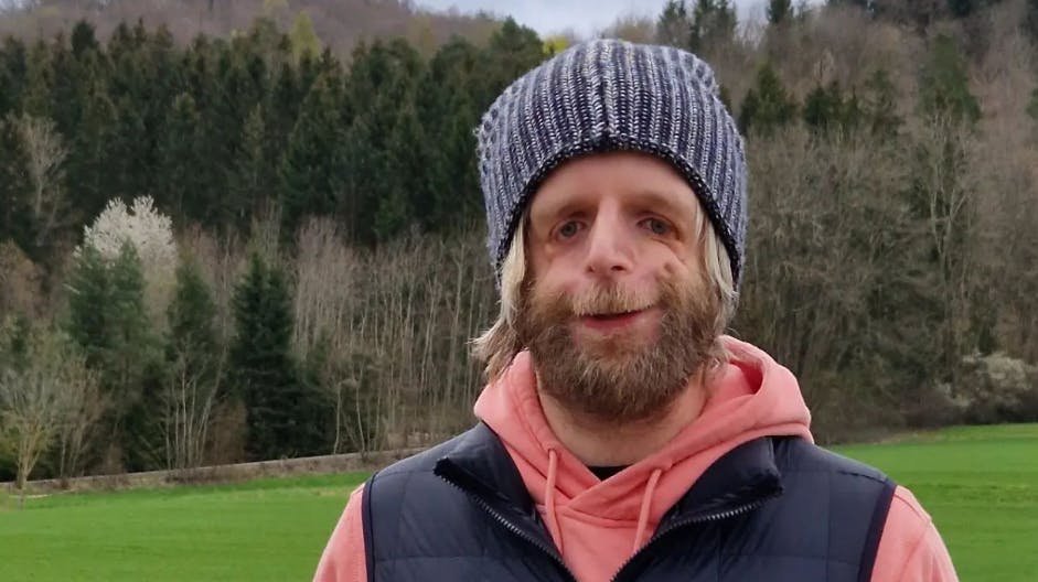 Jono Lancaster er født med det sjældne Treacher Collins-syndrom. 