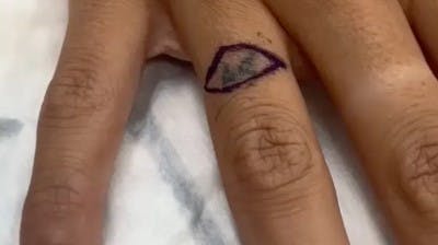 En kvinde var ikke tilfreds med sin tatovering, så hun fik den skåret af.