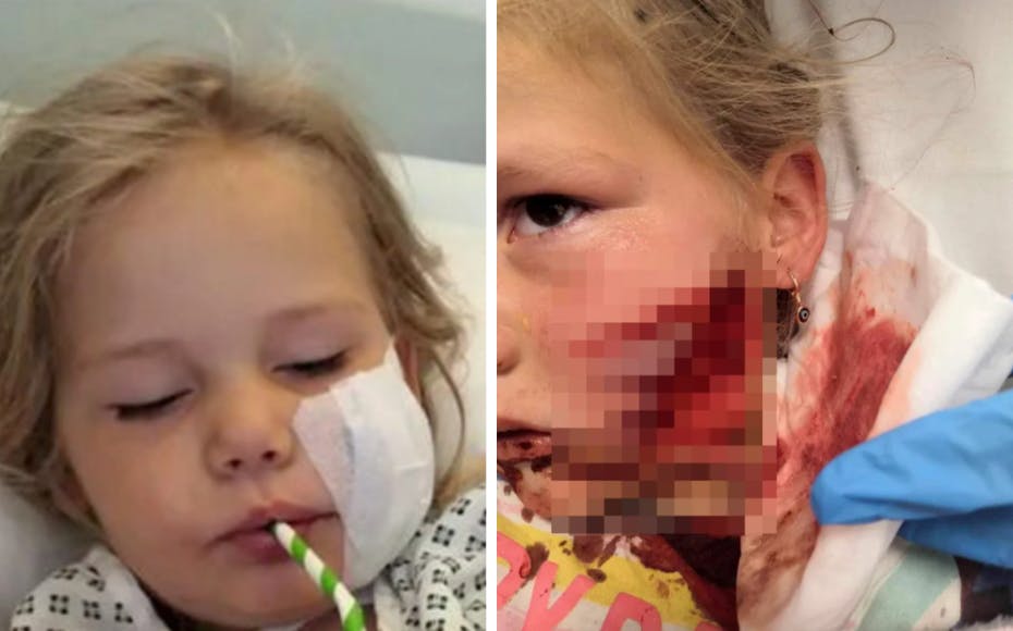 Femårige Farrah-Leigh Nichol blev lørdag bidt i ansigtet af en hund.&nbsp;