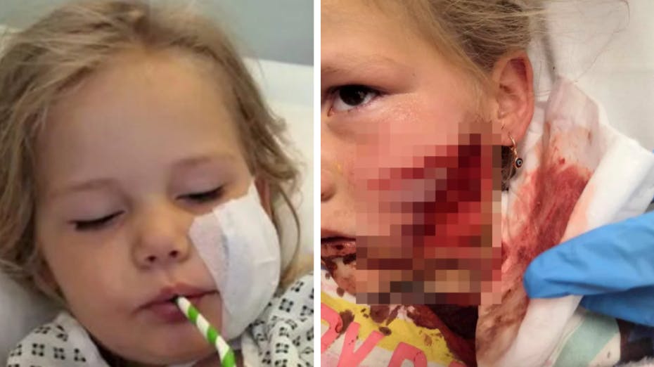 Femårige Farrah-Leigh Nichol blev lørdag bidt i ansigtet af en hund. 