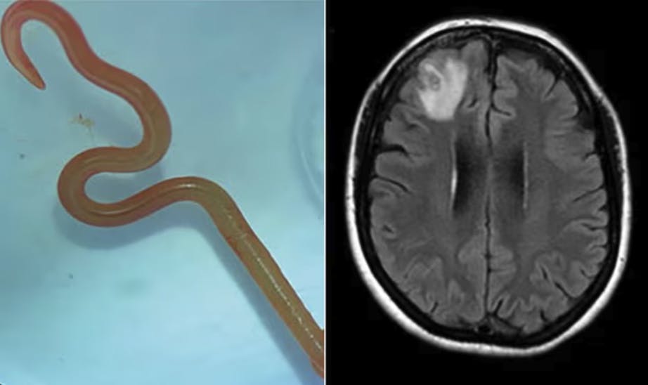 En otte centimeter lang rundorm er blevet fundet i hjernen på en australsk kvinde. Ormen blev fjernet fra den 64-årige kvindes hjerne under en operation i juni 2022.
