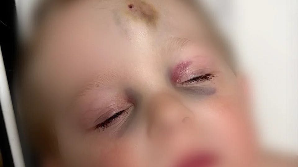 Selv efter en uge, var der tydelige skader i drengens ansigt 
