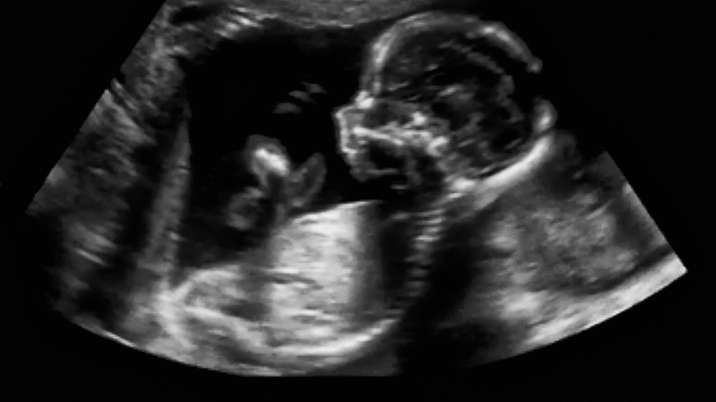 Obstetric Ultrasonography Ultrasound Echography of a fourth month fetus