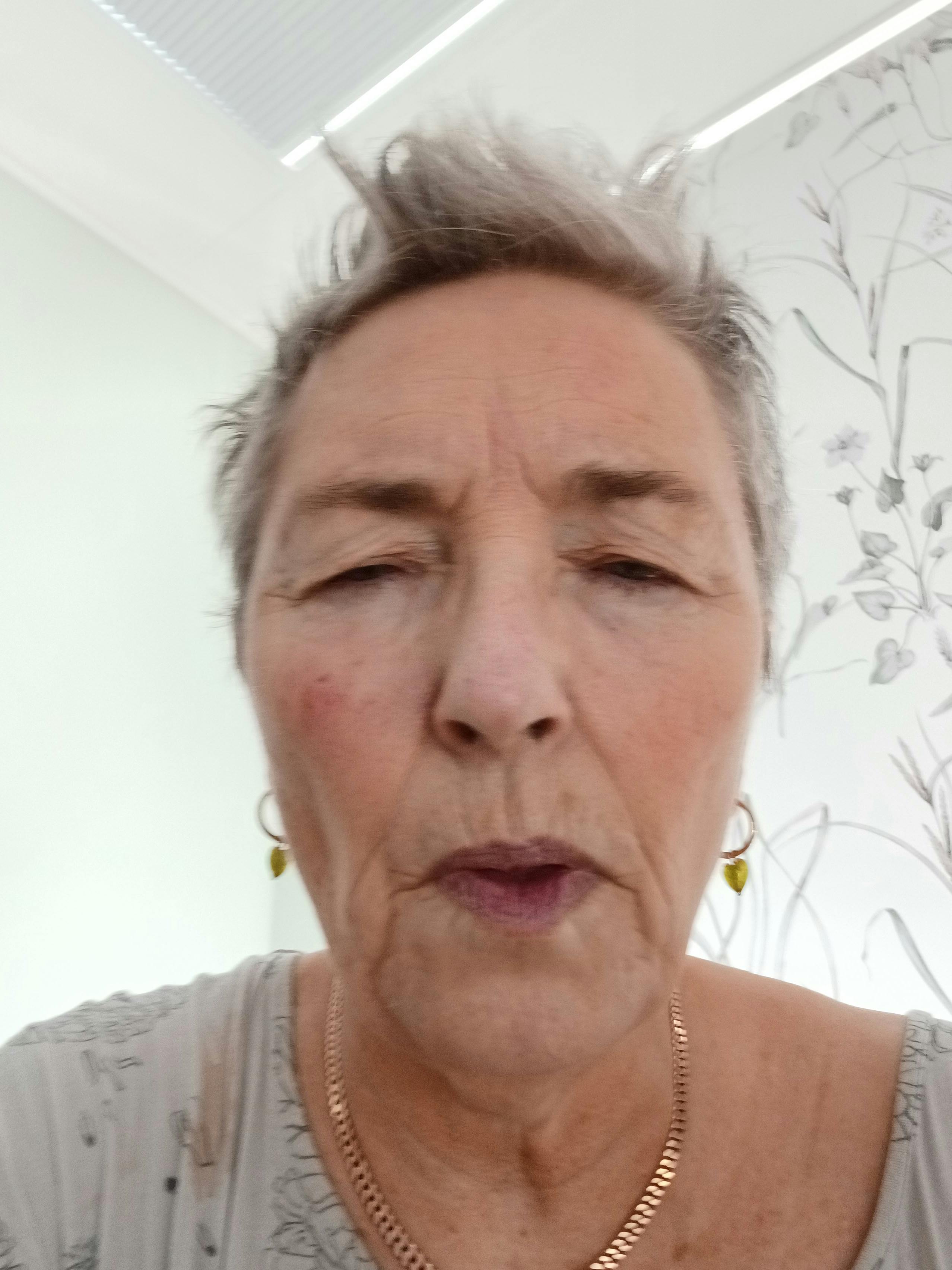 Sådan så Elise ud for to år siden, inden hun begyndte i antiviral behandling.